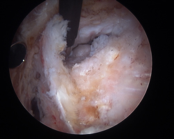 Endoscopic Abductor Tendon Repair